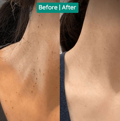 Remover Pen for Moles, Plasma pen, for Mole & Skin Tag & wart Removal, Mole Skin