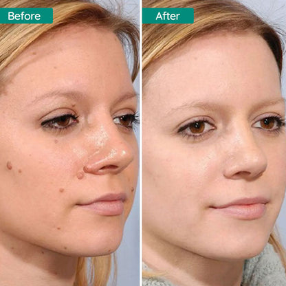 Remover Pen for Moles, Plasma pen, for Mole & Skin Tag & wart Removal, Mole Skin